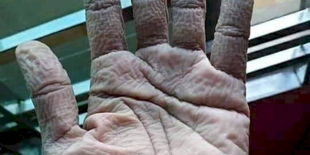 FOTO: así le quedó la mano a un medico tras usar los guantes protectores contra el coronavirus | Internacionales