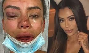 Una joven influencer relató en Instagram la paliza que le dio un hombre en una fiesta | Internacionales