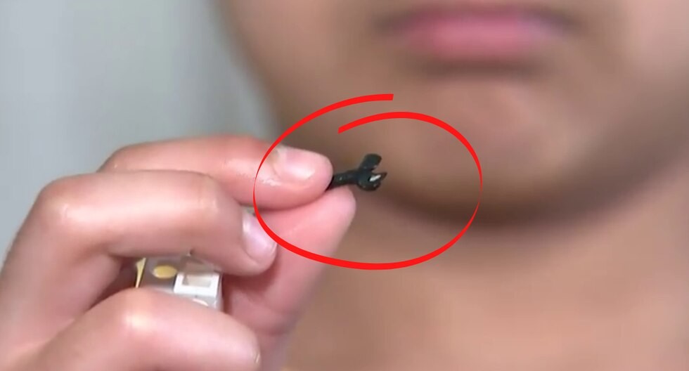 El nene de 7 años que vivió dos años con una pieza de Lego en la nariz | Internacionales