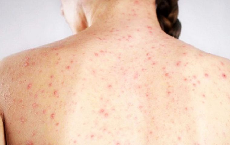 Argentina dio por terminado el brote de sarampión y lo informó a la OMS | Actualidad