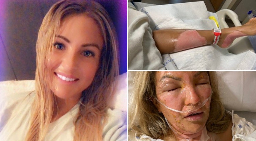 Encendió una vela tras usar desinfectante de manos y sufrió graves quemaduras | Internacionales