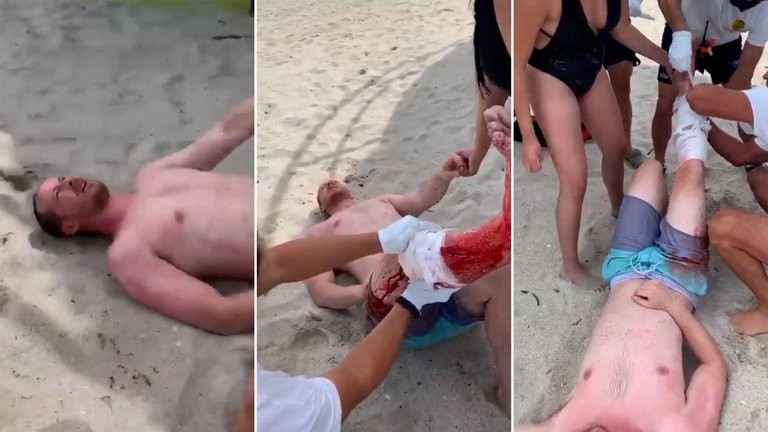 Video: un tiburón le mordió la pierna a un hombre en South Beach | Internacionales