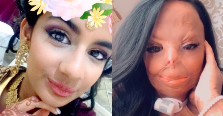 Se quemó al usar un champú contra los piojos y ahora es ejemplo de lucha: "Soy más fuerte que antes" | Internacionales