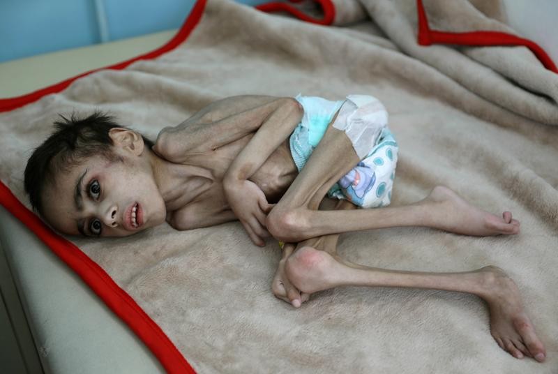 El drama de un nene de Yemen que pesa sólo 7 kilos y tiene parálisis cerebral | Internacionales