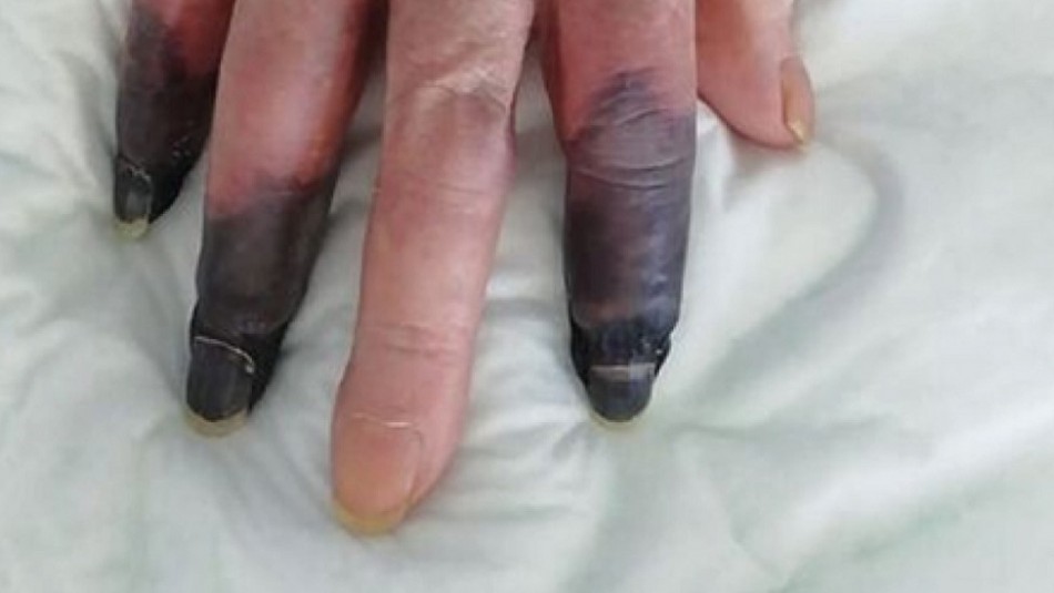 Una mujer perdió 3 dedos por la gangrena que le provocó el coronavirus | Internacionales