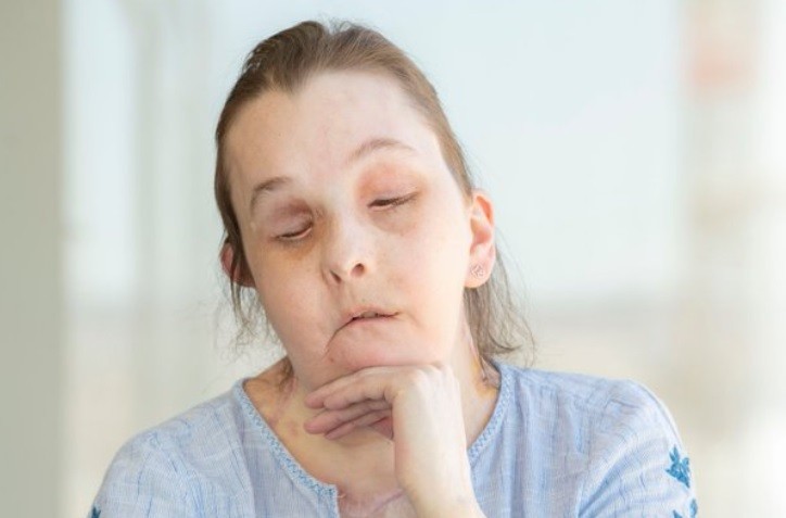 Mostró su rostro la mujer que recibió dos trasplantes de cara | Internacionales