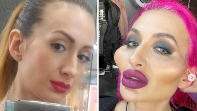 El escalofriante antes y después de la mujer con los pómulos más grandes del mundo | Internacionales