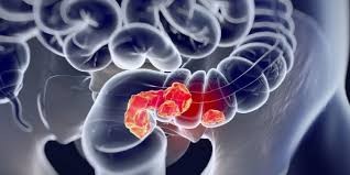 Día Mundial de la Prevención del Cáncer de Colon y Recto: prevención y control a partir de los 50 años para reducir casos | Salud