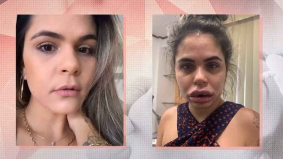 Video: una dentista acusada de deformarle la cara a decenas de pacientes con un tratamiento estético | Internacionales