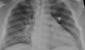 Qué es la neumonía bilateral, la enfermedad que produce más internaciones y muertes en pacientes con Cvid | Salud