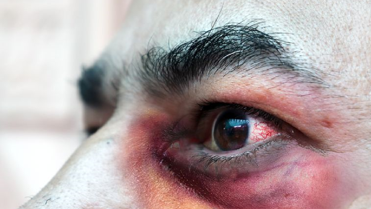 México registró su primer caso de Hongo Negro | Internacionales