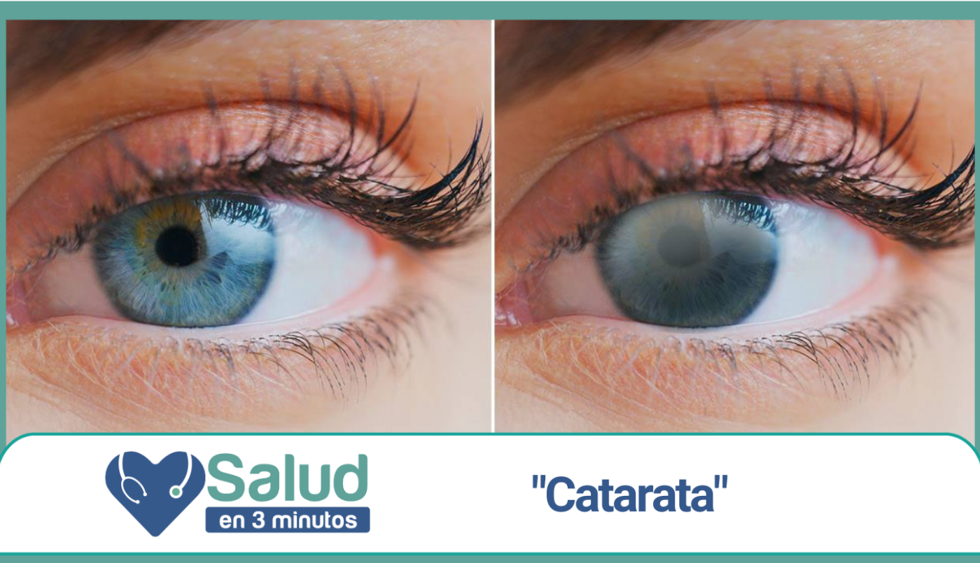 Las cataratas en los ojos ¿Son una enfermedad? | Salud