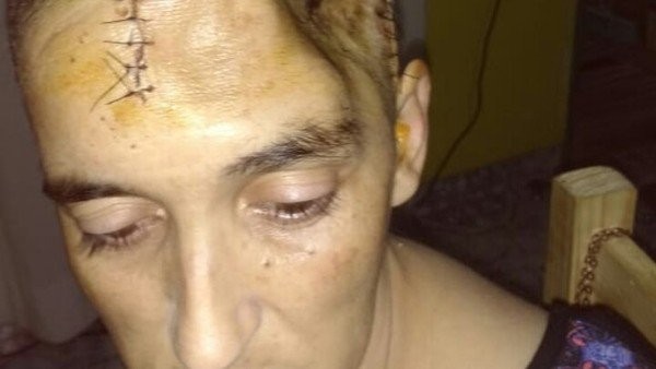 Creyó que era un dolor de muelas y le tuvieron que extirpar parte del cráneo | Internacionales