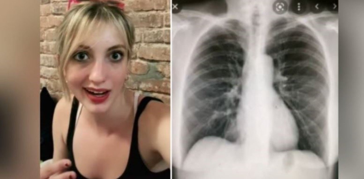 Fue al médico por una tos molesta y descubrieron que tenía el corazón del otro lado | Internacionales