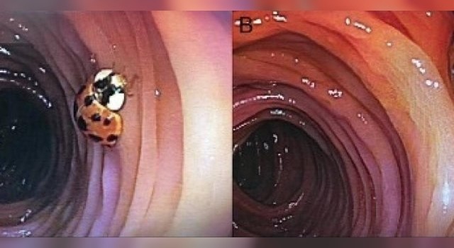 Descubrieron que un hombre tenía a una vaquita de San Antonio viviendo en el intestino | Internacionales