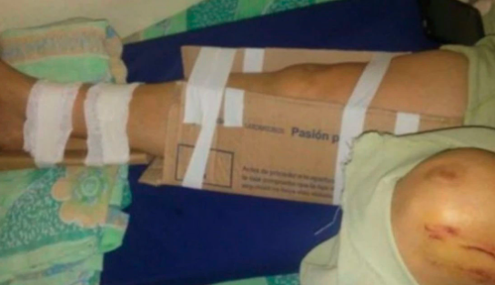 Llegó a un hospital de Chaco con una fractura expuesta y lo enyesaron con cartones | Actualidad