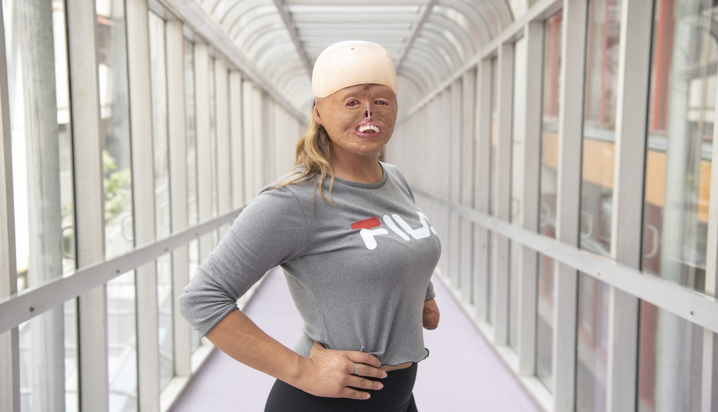 Brisa: a los 7 meses se quemó el 90% de su cuerpo y hoy es deportista y modelo | Actualidad