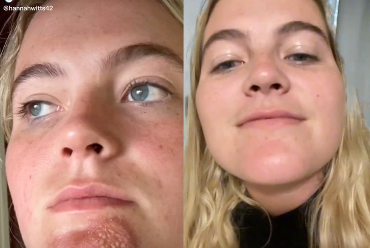 Una chica sufrió una grave infección tras besar a un hombre con barba | Curiosidades