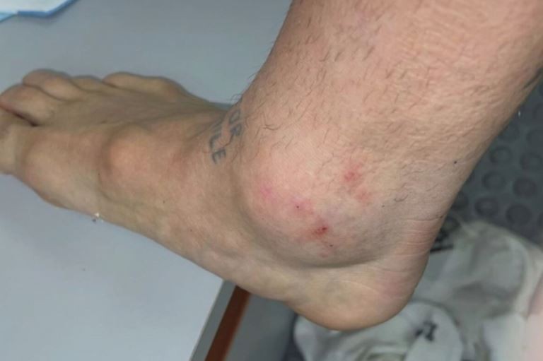 La impactante foto del tobillo del "Papu" Gómez tras el duelo con Chile | Deportes