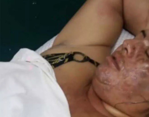 Hombre le tiró agua hirviendo a su pareja: "Tiene el 80% del rostro quemado" | Actualidad