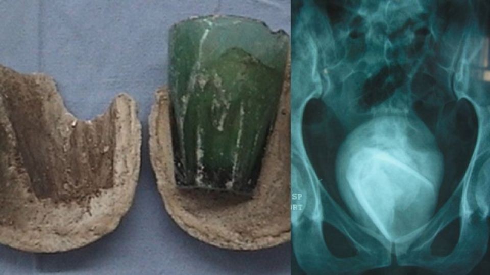 Fue al médico pensando que tenía una infección urinaria y le hallaron un vaso en la vejiga: lo usó como juguete sexual | Curiosidades