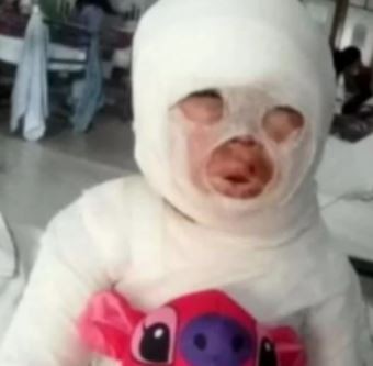 Una empleada de un restaurante se tropezó y le volcó aceite hirviendo a una nena de 3 años | Actualidad