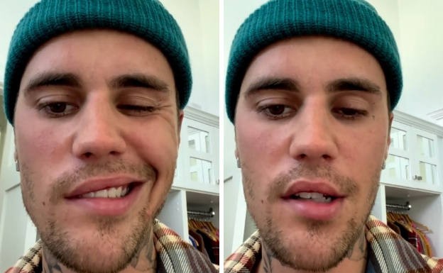 Justin Bieber, afectado por parálisis facial: cómo es esa dolencia | Espectáculos