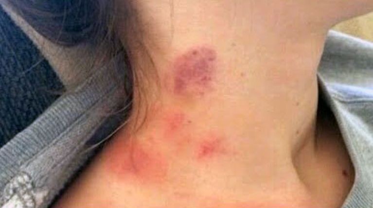 Una maestra descubrió que una niña era abusada por su padrastro en Orán por una marca en el cuello | Actualidad