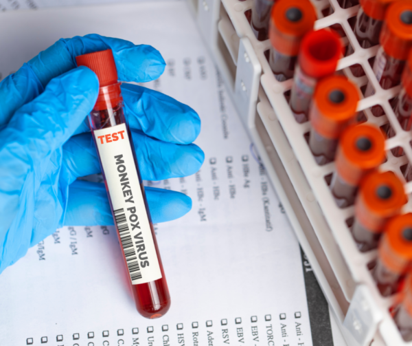 Dos nuevos casos de viruela del mono en Argentina | Actualidad