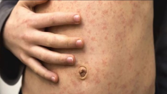 Emergencia Sanitaria Internacional por la viruela del mono: cómo es la situación en Argentina | Actualidad