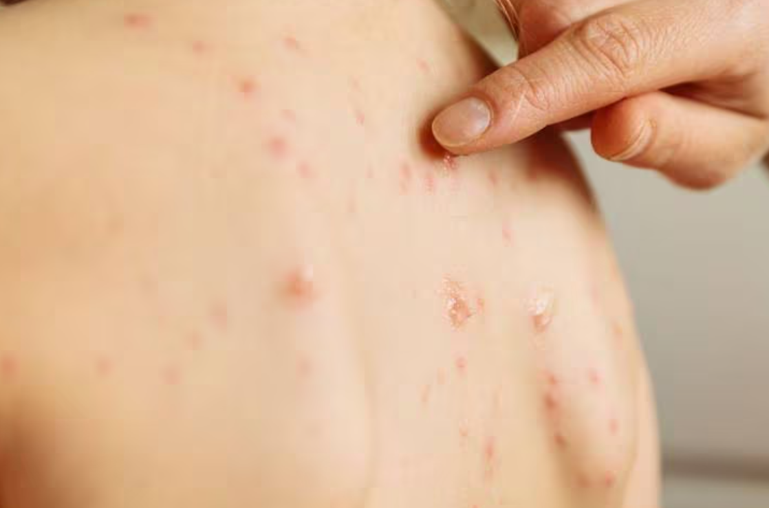 Confirman otro caso de sarampión en la Ciudad de Buenos Aires: ya suman tres en el país | Actualidad