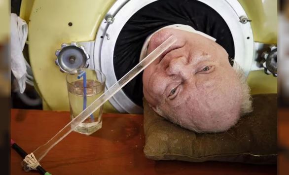 Murió Paul Alexander, el hombre que vivió durante más de 70 años conectado a un pulmón de hierro | Internacionales