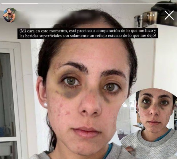 Un fisicoculturista golpeó brutalmente a su pareja en Alta Gracia | Córdoba