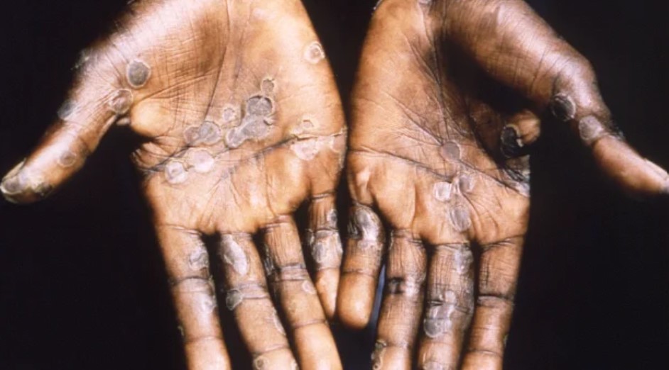 Emergencia global por la viruela del mono: cuántos casos confirmados hay en la Argentina | Actualidad