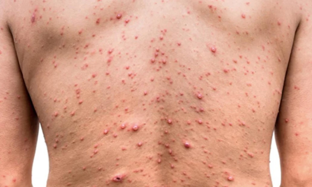 Detectaron siete nuevos casos de viruela del mono en Argentina | Actualidad