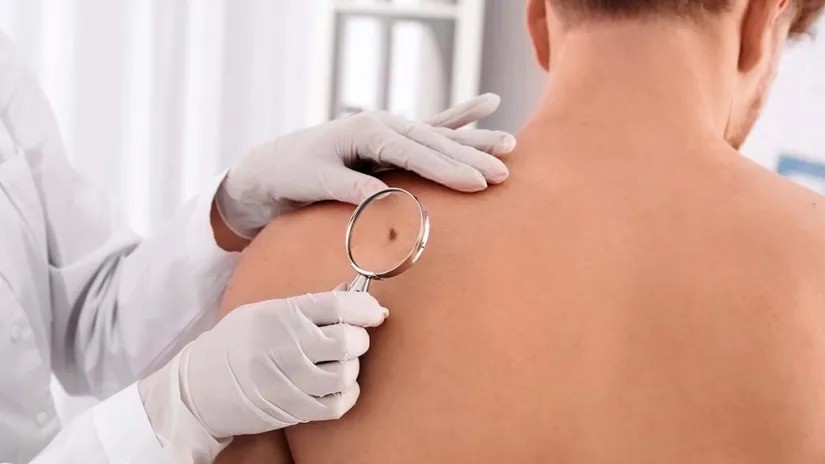 La Municipalidad de Córdoba ofrece controles de lunares de forma gratuita | Córdoba