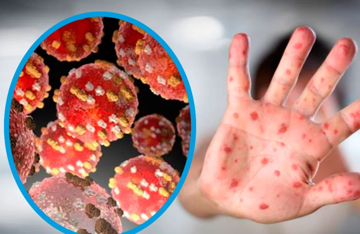 Reportaron 11 nuevos casos de la viruela del mono: siete en la Ciudad de Buenos Aires y el resto en la provincia | Actualidad