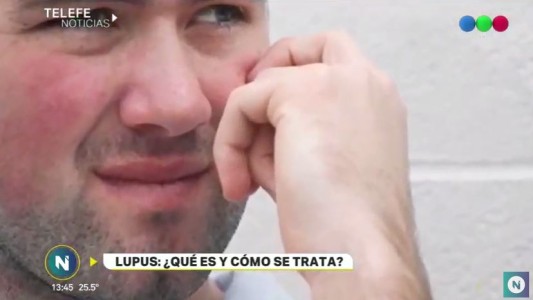 Lupus: ¿Qué es y cómo se trata?