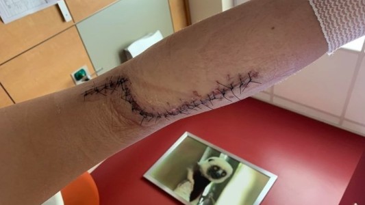 Al volver de la playa su hija de 12 años no podía caminar: casi muere por la bacteria "come carne"