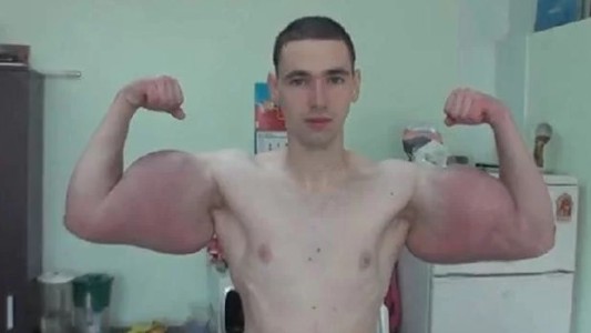 El drama del "Hulk" ruso: no soporta el dolor y quiere salvar sus brazos de la amputación