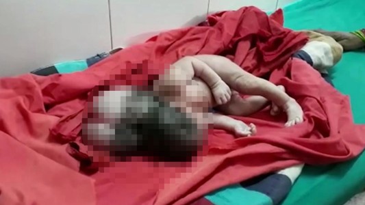 Conmoción por el nacimiento de una bebé de tres cabezas