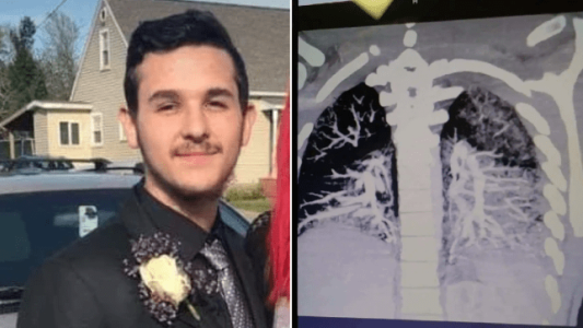 Impactante radiografía del joven de 19 años que tiene pulmones de un fumador de 60 por el cigarrillo electrónico