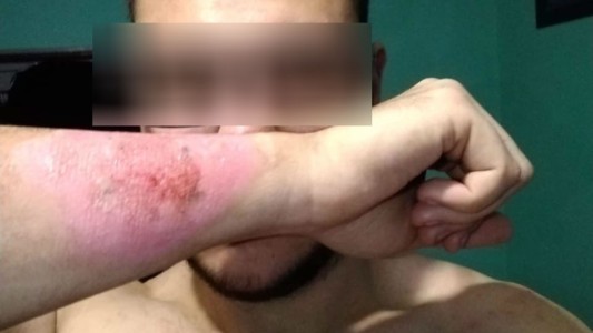 Se hizo un tatuaje, no le gustó y se lo sacó con un rallador de queso