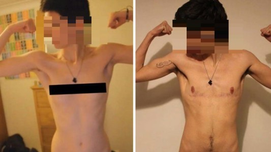 Un juez autorizó a quitarse las mamas a joven trans de 16 años en San Juan