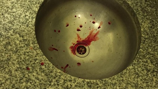 Alerta en La Plata: dos alumnos se contagiaron tuberculosis