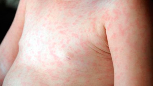 Buenos Aires: se confirmaron que ya son los 61 casos de sarampión