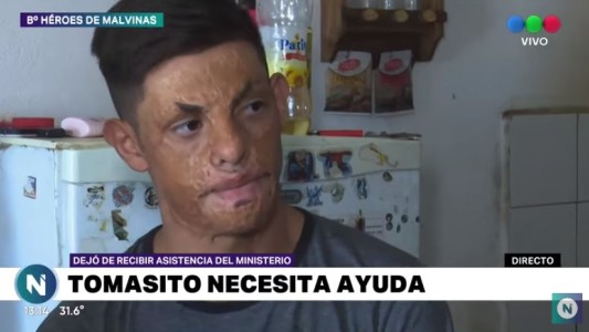 Todos por Tomás: sufrió severas quemaduras y necesita una operación en sus manos