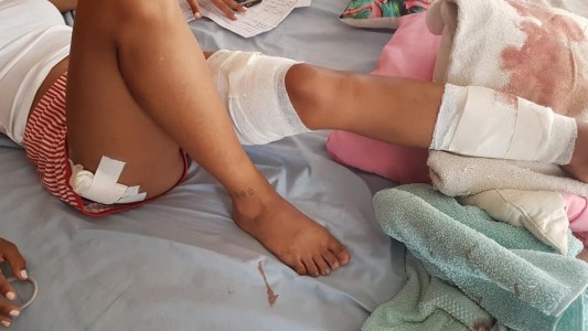 Otra vez: feroz ataque de dos perros pitbull a una joven en Mar del Plata