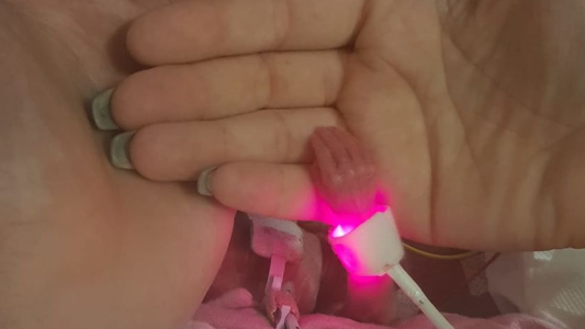 El milagro de Isabella: cuando nació pesaba 340 gramos y sus manos eran más chicas que una moneda