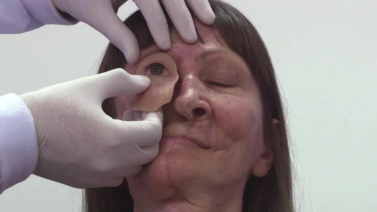 VIDEO: prótesis de bajo costo para sobrevivientes de cáncer